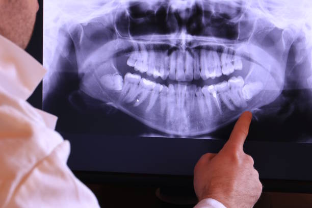 Best Emergency Wisdom Teeth Removal in Lebanon, OH